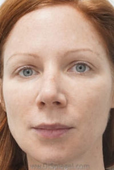 Botox / Dysport / Jeuveau / Xeomin Before & After Gallery - Patient 197717 - Image 4