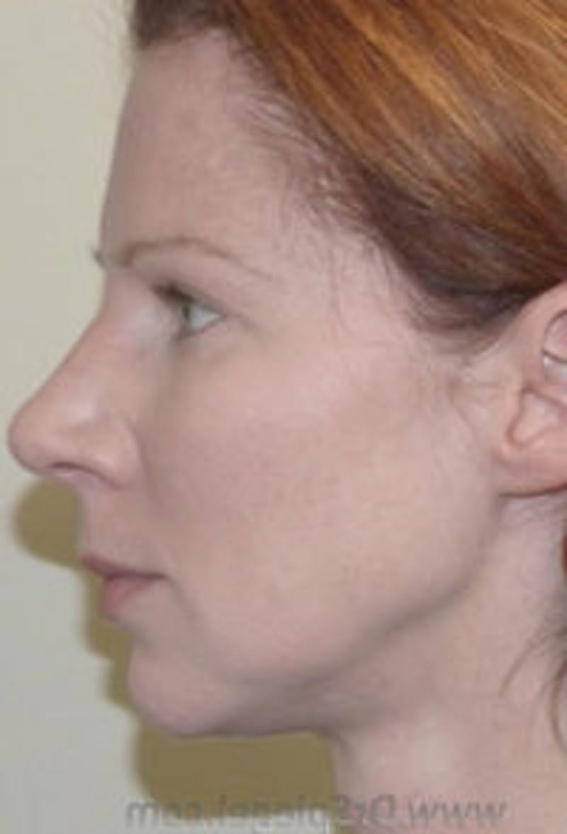 Botox / Dysport / Jeuveau / Xeomin Before & After Gallery - Patient 197717 - Image 5