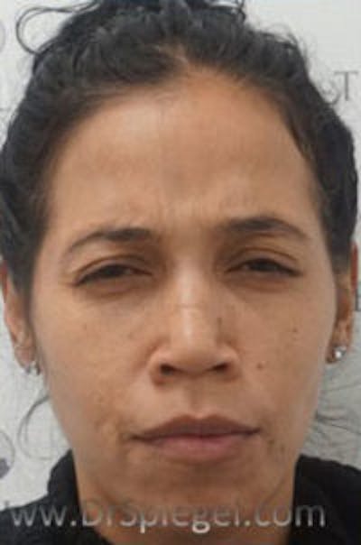 Botox / Dysport / Jeuveau / Xeomin Before & After Gallery - Patient 570198 - Image 2