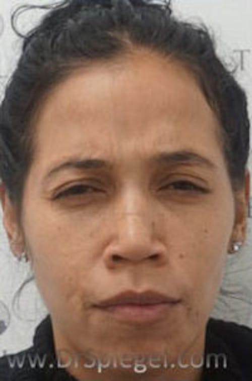 Botox / Dysport / Jeuveau / Xeomin Before & After Gallery - Patient 570198 - Image 2