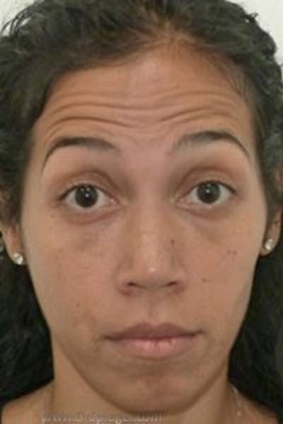 Botox / Dysport / Jeuveau / Xeomin Before & After Gallery - Patient 570198 - Image 3