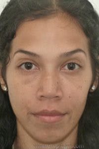Botox / Dysport / Jeuveau / Xeomin Before & After Gallery - Patient 570198 - Image 4