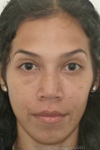 Botox / Dysport / Jeuveau / Xeomin Before & After Gallery - Patient 570198 - Image 4