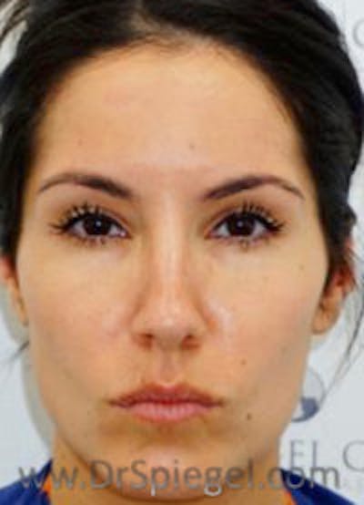 Botox / Dysport / Jeuveau / Xeomin Before & After Gallery - Patient 284240 - Image 2