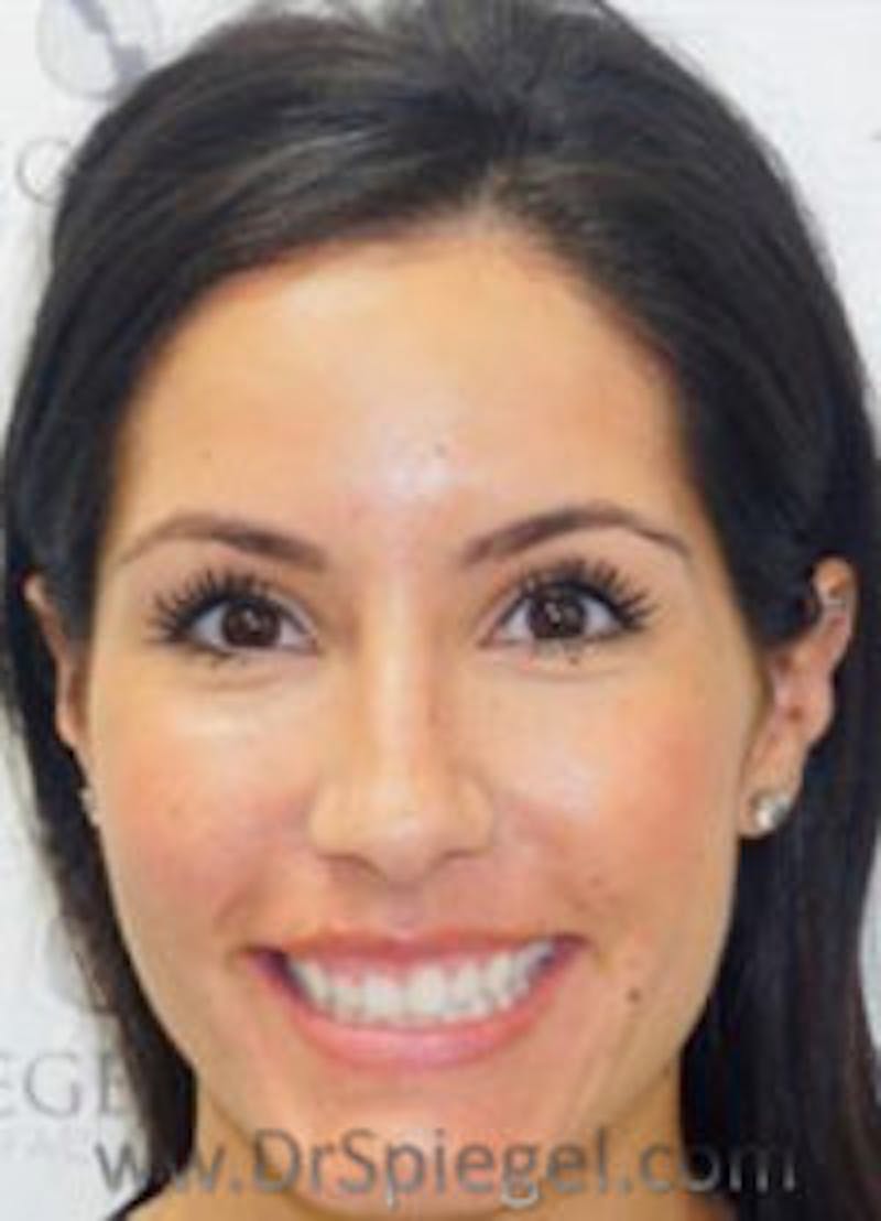 Botox / Dysport / Jeuveau / Xeomin Before & After Gallery - Patient 284240 - Image 3