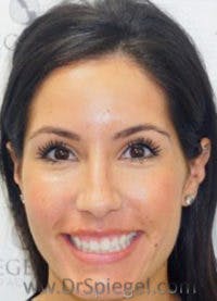 Botox / Dysport / Jeuveau / Xeomin Before & After Gallery - Patient 284240 - Image 3