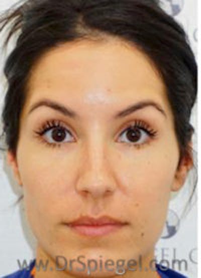 Botox / Dysport / Jeuveau / Xeomin Before & After Gallery - Patient 284240 - Image 4