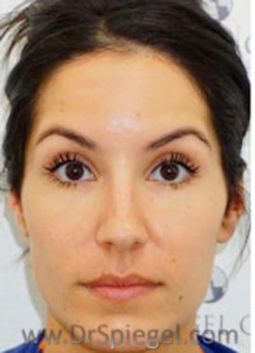 Botox / Dysport / Jeuveau / Xeomin Before & After Gallery - Patient 284240 - Image 4