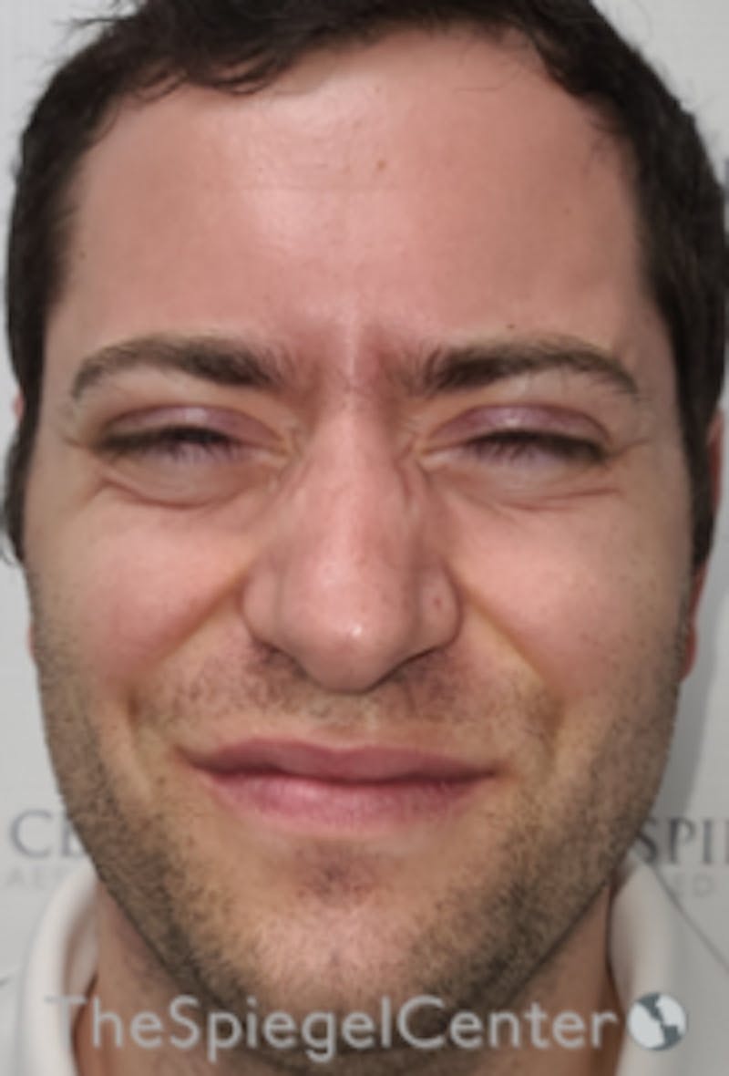 Botox / Dysport / Jeuveau / Xeomin Before & After Gallery - Patient 593974 - Image 1