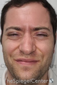 Botox / Dysport / Jeuveau / Xeomin Before & After Gallery - Patient 593974 - Image 1