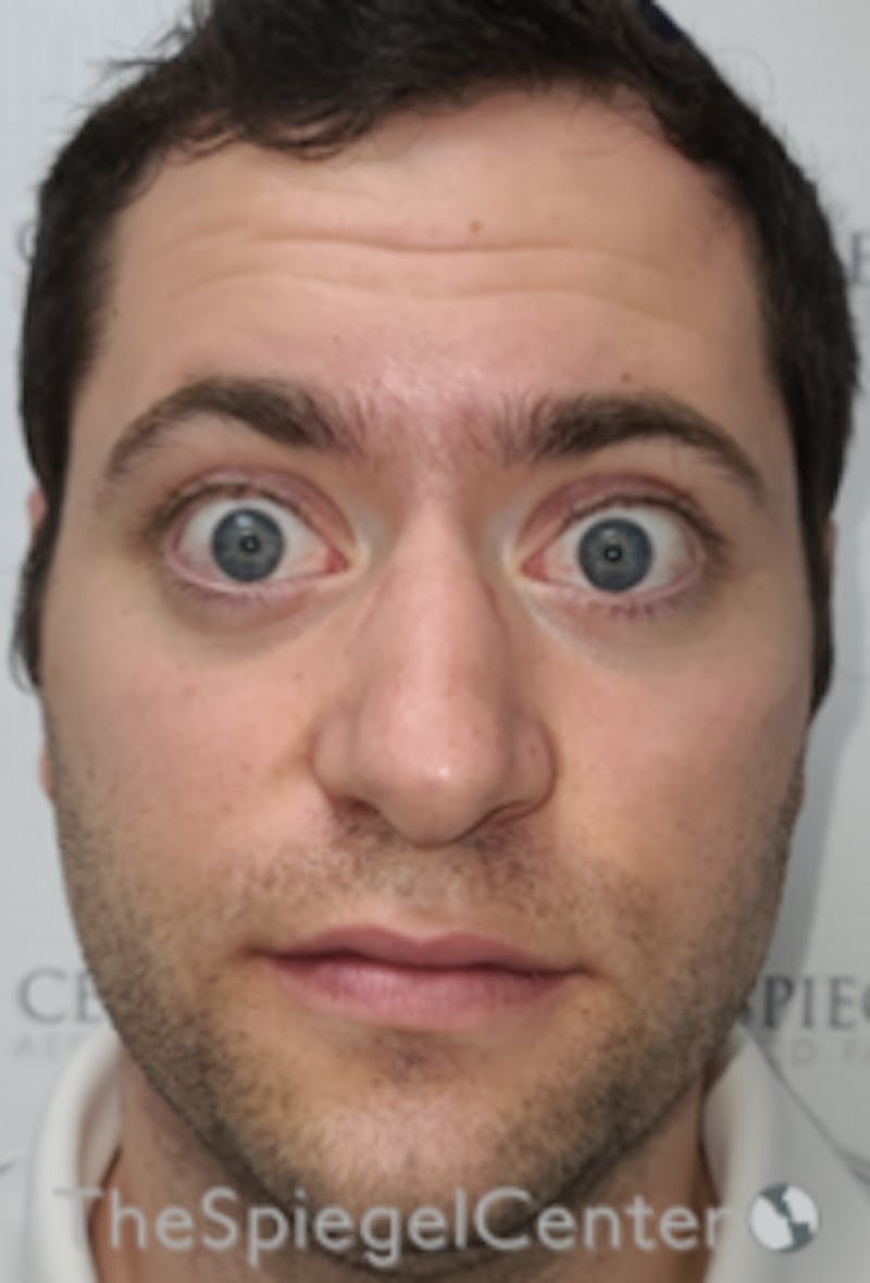 Botox / Dysport / Jeuveau / Xeomin Before & After Gallery - Patient 593974 - Image 3