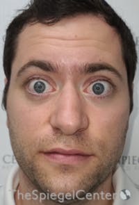 Botox / Dysport / Jeuveau / Xeomin Before & After Gallery - Patient 593974 - Image 3