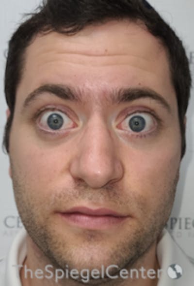 Botox / Dysport / Jeuveau / Xeomin Before & After Gallery - Patient 593974 - Image 3