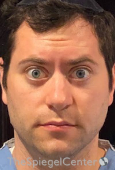 Botox / Dysport / Jeuveau / Xeomin Before & After Gallery - Patient 593974 - Image 4