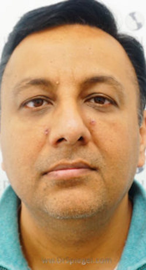 Botox / Dysport / Jeuveau / Xeomin Before & After Gallery - Patient 216579 - Image 2