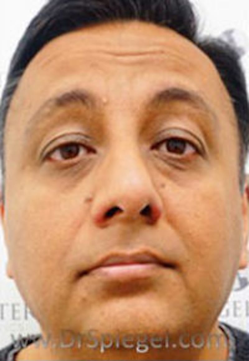 Botox / Dysport / Jeuveau / Xeomin Before & After Gallery - Patient 216579 - Image 3