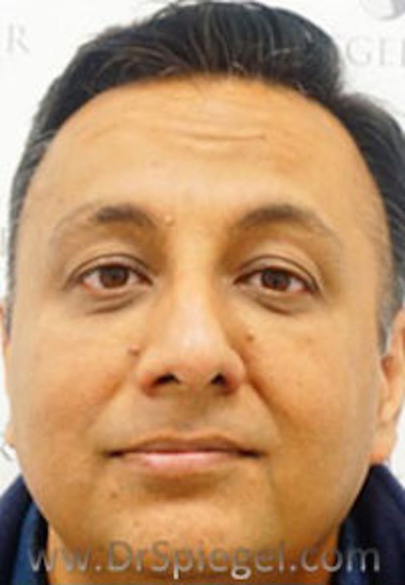 Botox / Dysport / Jeuveau / Xeomin Before & After Gallery - Patient 216579 - Image 4