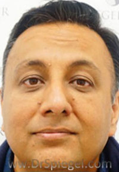 Botox / Dysport / Jeuveau / Xeomin Before & After Gallery - Patient 216579 - Image 4