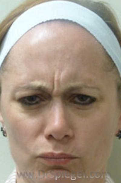 Botox / Dysport / Jeuveau / Xeomin Before & After Gallery - Patient 437622 - Image 1