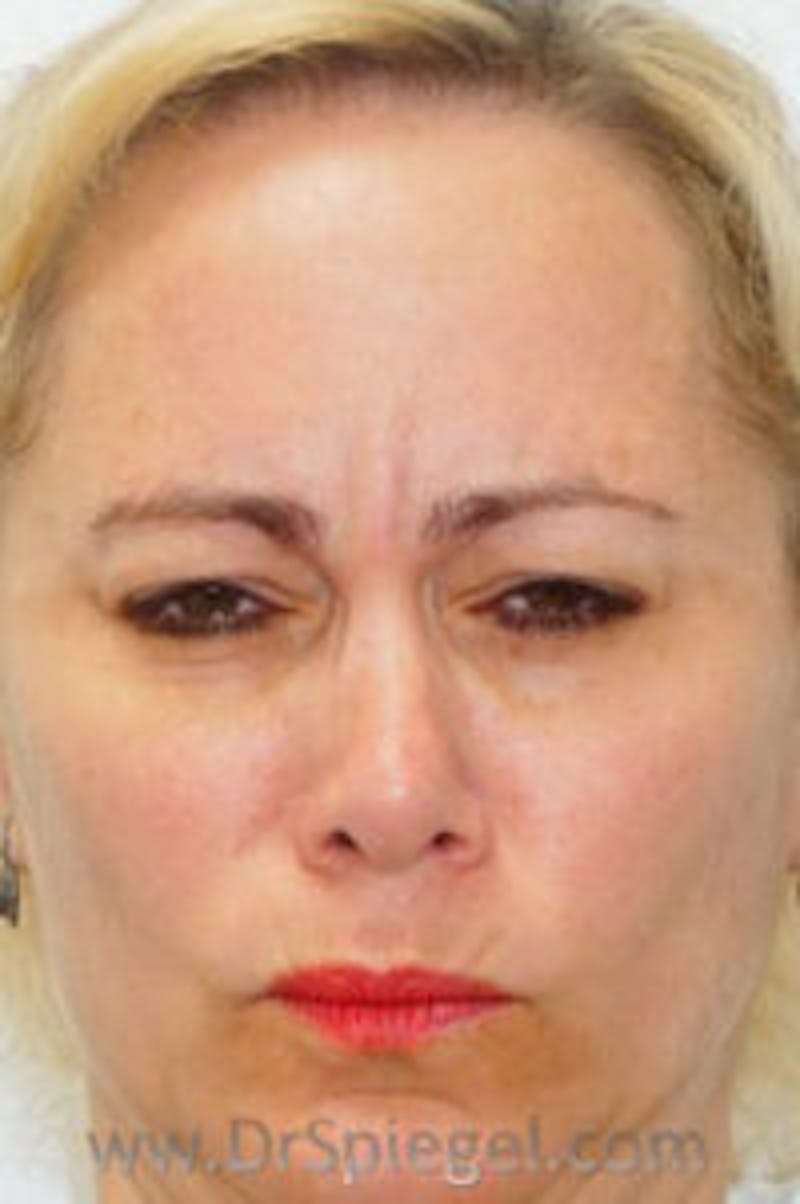 Botox / Dysport / Jeuveau / Xeomin Before & After Gallery - Patient 437622 - Image 2