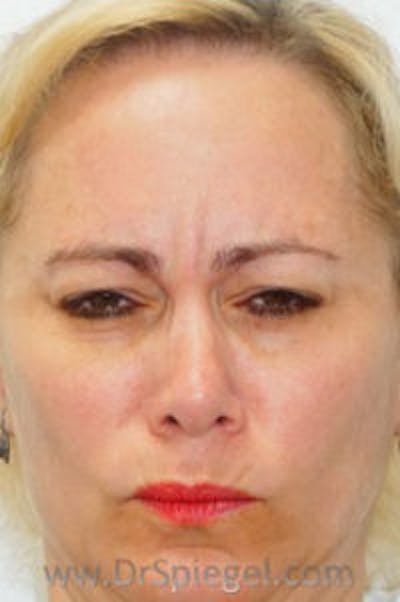 Botox / Dysport / Jeuveau / Xeomin Before & After Gallery - Patient 437622 - Image 2