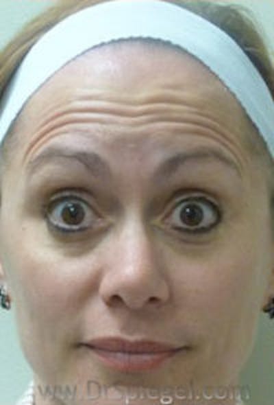Botox / Dysport / Jeuveau / Xeomin Before & After Gallery - Patient 437622 - Image 3