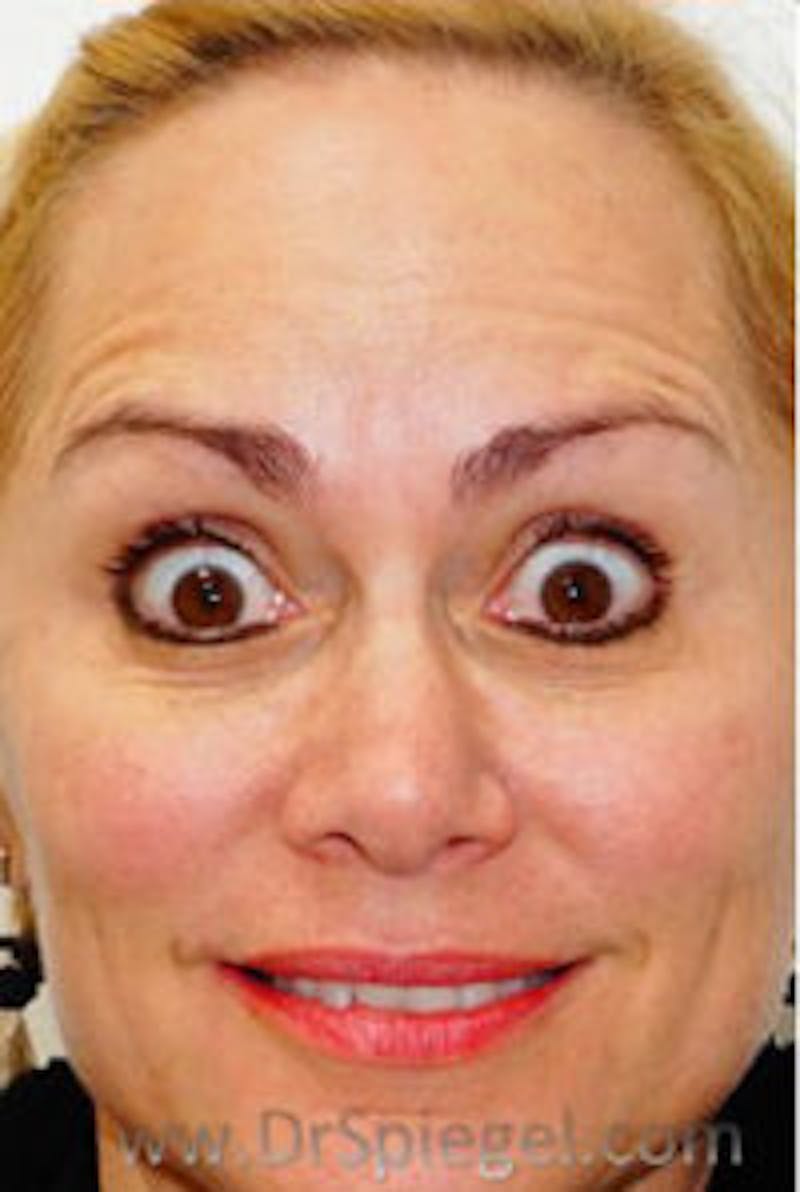 Botox / Dysport / Jeuveau / Xeomin Before & After Gallery - Patient 437622 - Image 4