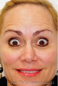 Botox / Dysport / Jeuveau / Xeomin Before & After Gallery - Patient 437622 - Image 4