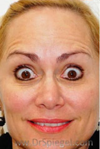 Botox / Dysport / Jeuveau / Xeomin Before & After Gallery - Patient 437622 - Image 4