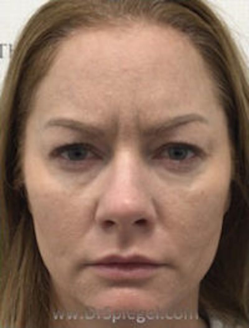 Botox / Dysport / Jeuveau / Xeomin Before & After Gallery - Patient 220896 - Image 1