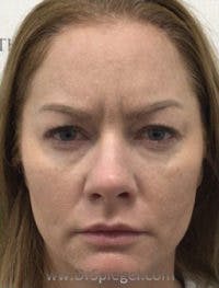 Botox / Dysport / Jeuveau / Xeomin Before & After Gallery - Patient 220896 - Image 1