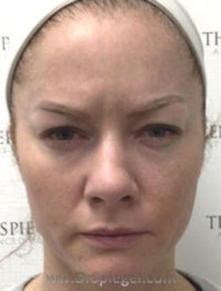 Botox / Dysport / Jeuveau / Xeomin Before & After Gallery - Patient 220896 - Image 2