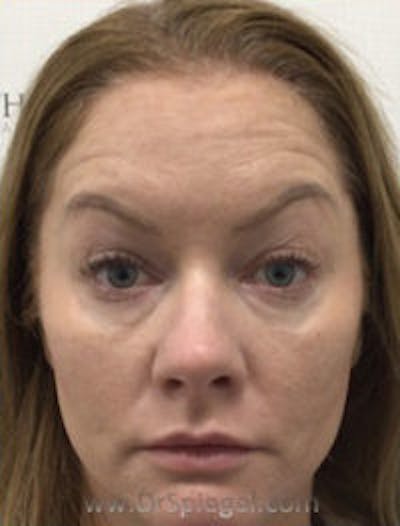 Botox / Dysport / Jeuveau / Xeomin Before & After Gallery - Patient 220896 - Image 3