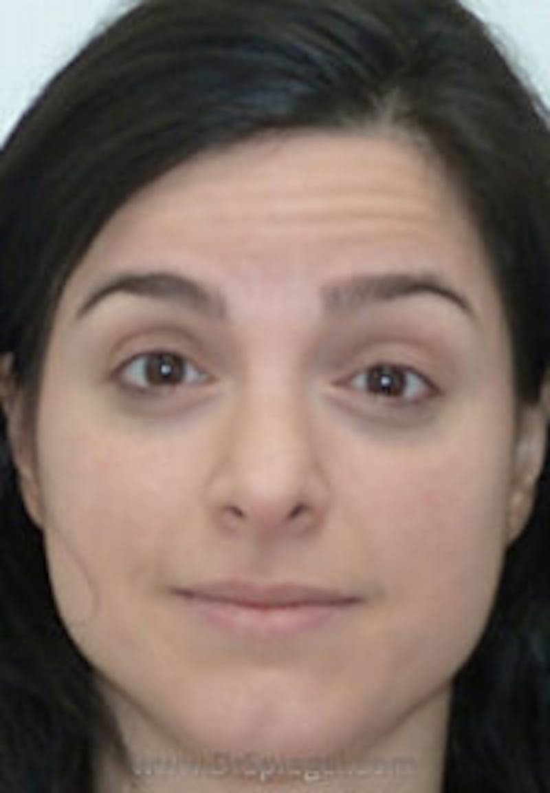 Botox / Dysport / Jeuveau / Xeomin Before & After Gallery - Patient 280656 - Image 1