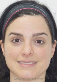 Botox / Dysport / Jeuveau / Xeomin Before & After Gallery - Patient 280656 - Image 2