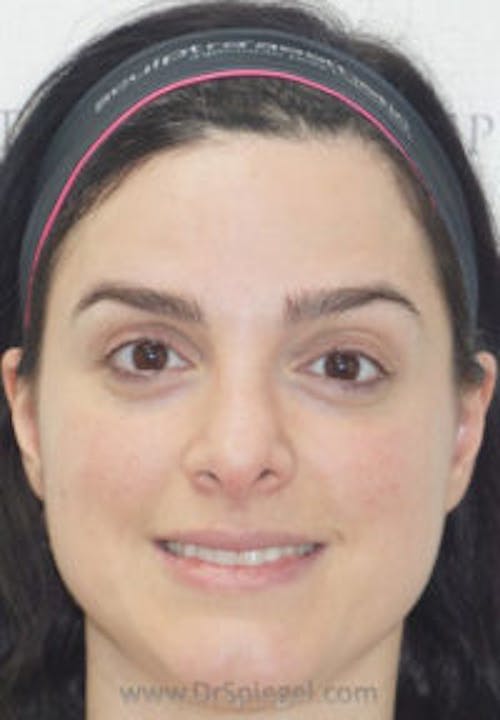 Botox / Dysport / Jeuveau / Xeomin Before & After Gallery - Patient 280656 - Image 2