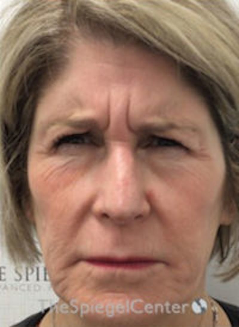 Botox / Dysport / Jeuveau / Xeomin Before & After Gallery - Patient 130255 - Image 1