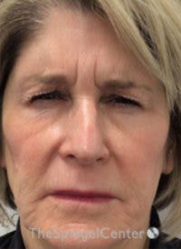 Botox / Dysport / Jeuveau / Xeomin Before & After Gallery - Patient 130255 - Image 2