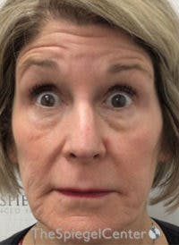 Botox / Dysport / Jeuveau / Xeomin Before & After Gallery - Patient 130255 - Image 3