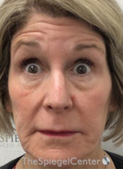 Botox / Dysport / Jeuveau / Xeomin Before & After Gallery - Patient 130255 - Image 3