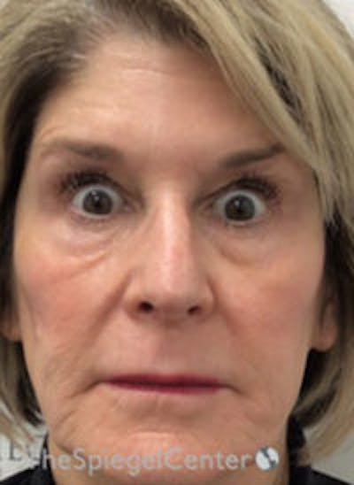 Botox / Dysport / Jeuveau / Xeomin Before & After Gallery - Patient 130255 - Image 4