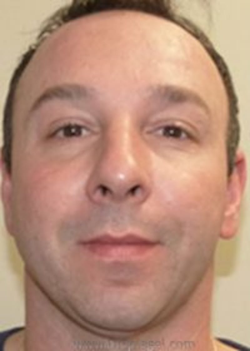 Botox / Dysport / Jeuveau / Xeomin Before & After Gallery - Patient 128613 - Image 2