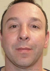 Botox / Dysport / Jeuveau / Xeomin Before & After Gallery - Patient 128613 - Image 2