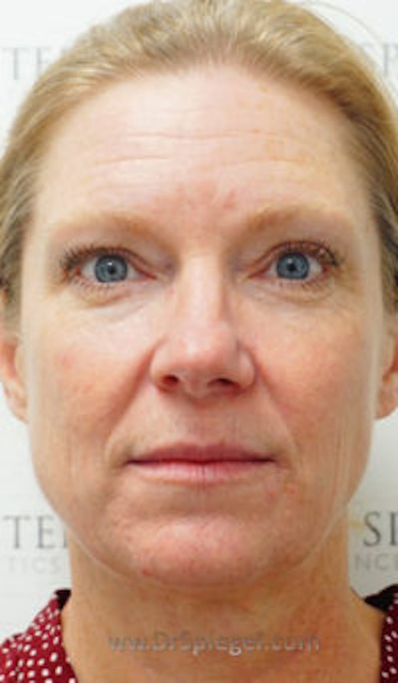Botox / Dysport / Jeuveau / Xeomin Before & After Gallery - Patient 116482 - Image 1