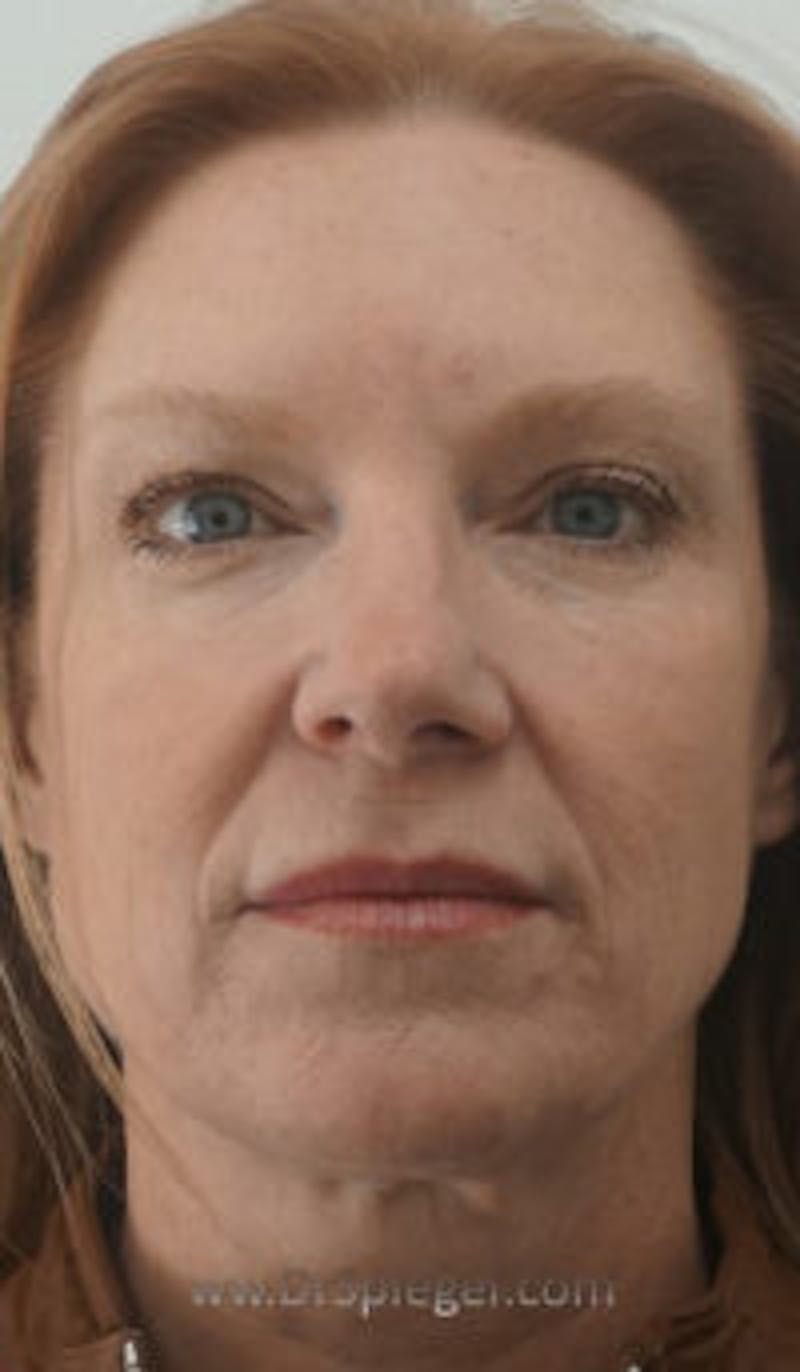 Botox / Dysport / Jeuveau / Xeomin Before & After Gallery - Patient 116482 - Image 2