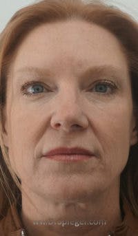 Botox / Dysport / Jeuveau / Xeomin Before & After Gallery - Patient 116482 - Image 2