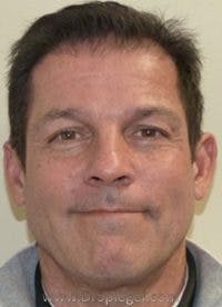Botox / Dysport / Jeuveau / Xeomin Before & After Gallery - Patient 291470 - Image 1