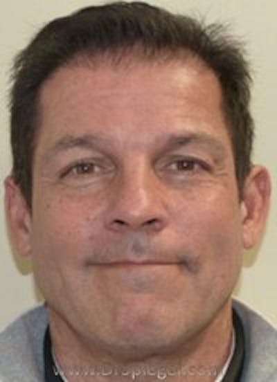 Botox / Dysport / Jeuveau / Xeomin Before & After Gallery - Patient 291470 - Image 1