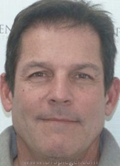 Botox / Dysport / Jeuveau / Xeomin Before & After Gallery - Patient 291470 - Image 2