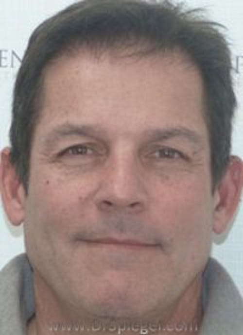Botox / Dysport / Jeuveau / Xeomin Before & After Gallery - Patient 291470 - Image 2